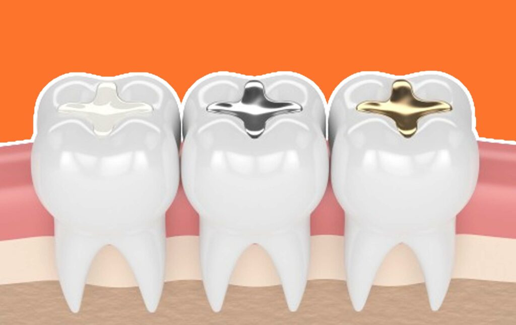 Does Insurance Cover Dental Sealants